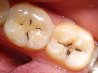 Зубы до лечения кариеса