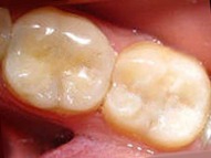 Зубы после удаления кариеса