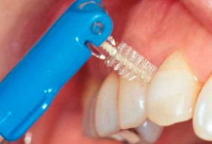 Чистка зубов с помощью межзубных ершиков