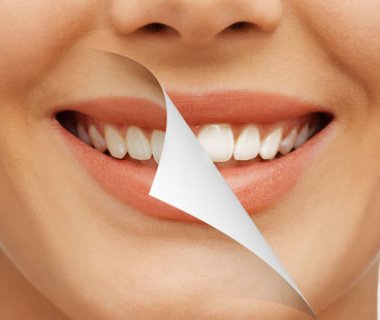 Отбеливание зубов: методики и результаты