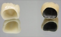 Установка керамической коронка на зуб