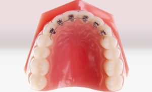 Экспресс-метод исправления прикуса зубов брекетами (частичная дуга)