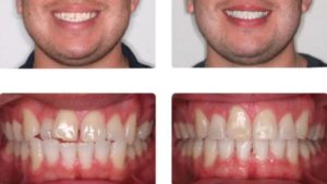 Выравнивание зубов у взрослых в стоматологии